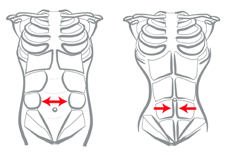 diastasis recti